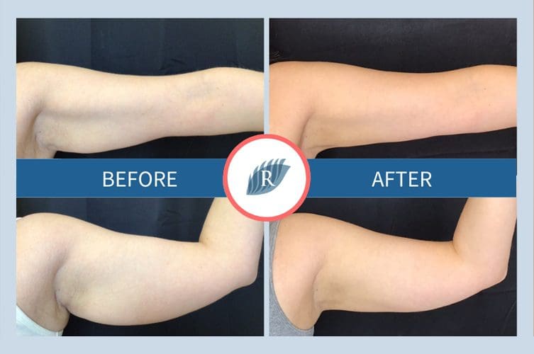 CoolSculpting Arms Before & After