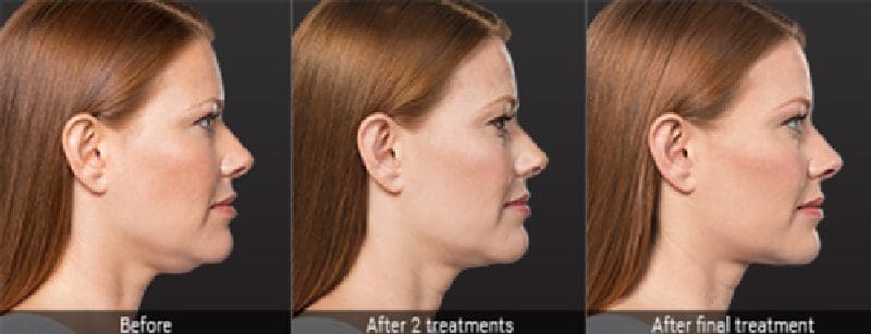 before and after two treatments of kybella