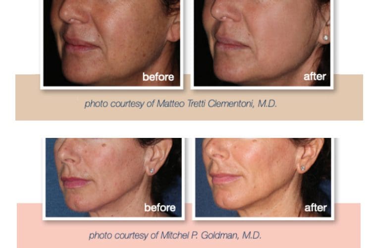 Profractional Before and After Photos